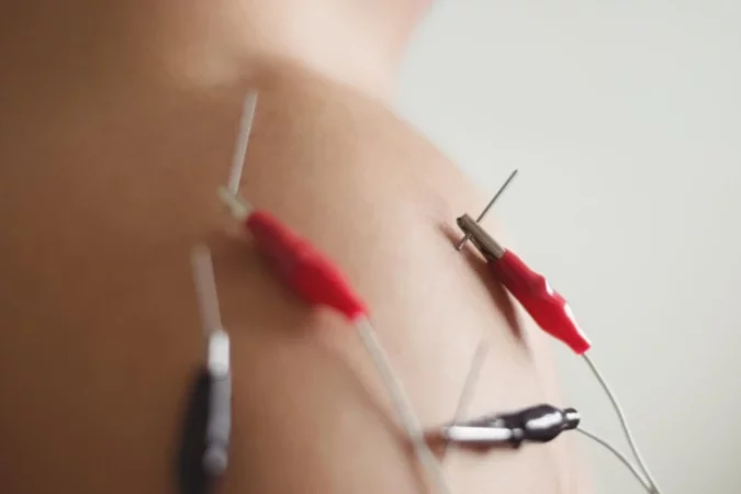 fisioterapia electro estimulacion percutanea